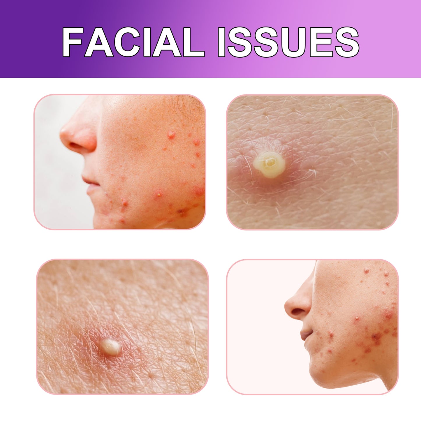 Jaysuing Acne Patches, Lightening Facial Acne Pimples Closed Repair Balance Skin Delicate Pore Care
