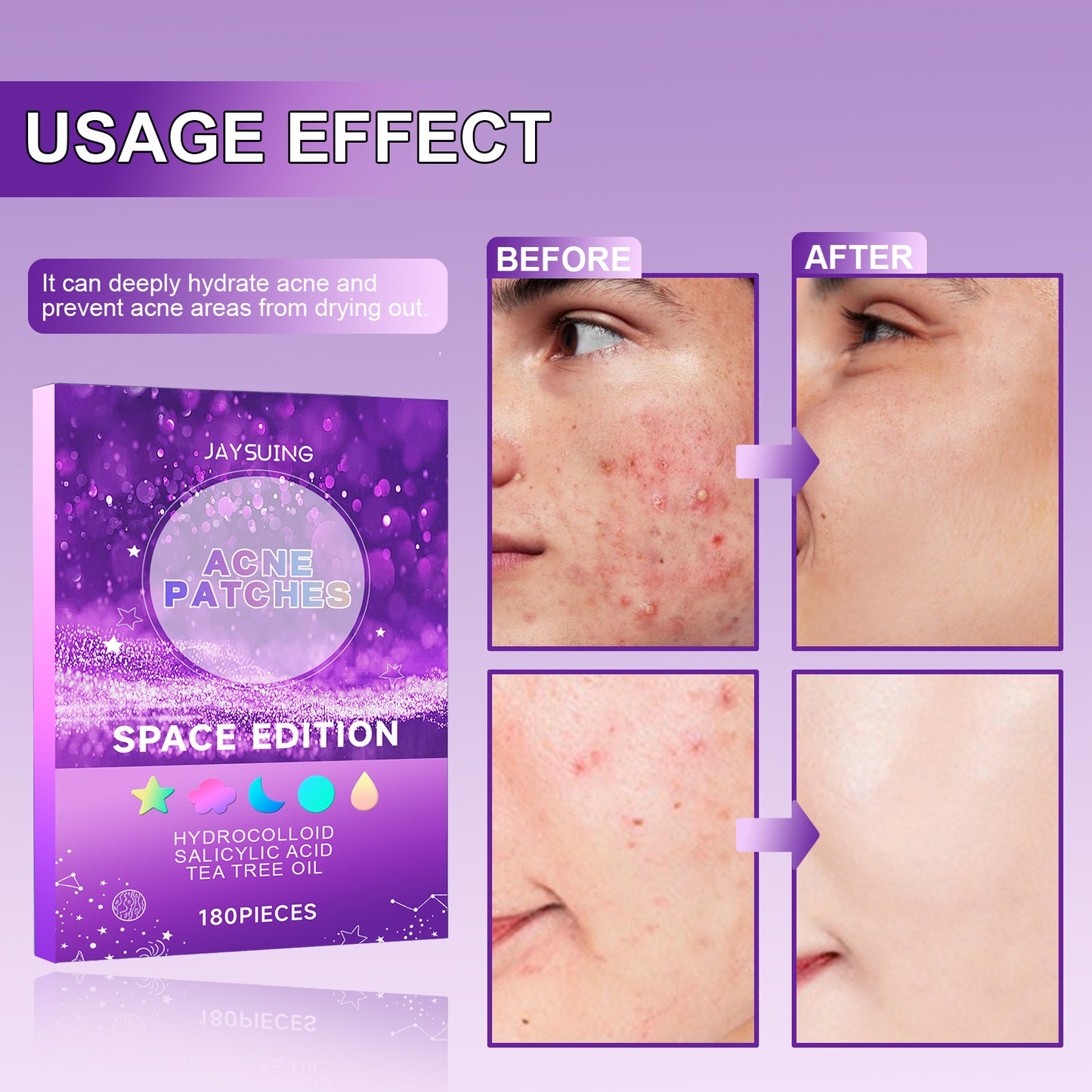 Jaysuing Acne Patches, Lightening Facial Acne Pimples Closed Repair Balance Skin Delicate Pore Care